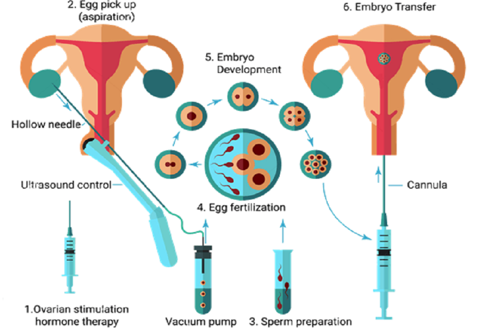 IN VITRO FERTILIZATION (IVF)